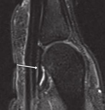 High-Resolution MRI of the Fingers Fig. 10 Volar plate., 33-year-old healthy male volunteer.