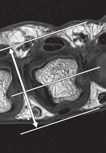 High-Resolution MRI of the Fingers Reconstr Surg 2000; 106:1592 1603 of the proximal interphalangeal joint. J Hand metacarpophalangeal joints of the finger. Part 2. 35. Kleinert HE, Verdan.