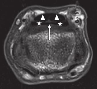 tendon (triangle). Lines a and b correspond to level of axial images in and, respectively.