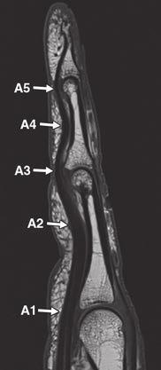 FDP tendon (triangle).