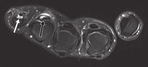, xial proton density weighted fat-suppressed image at level of third metacarpophalangeal joint shows 1 pulley (arrows).
