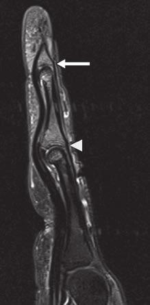 level of mid diaphysis of proximal phalanx (arrow). Fig. 5 63-year-old man with right middle trigger finger.