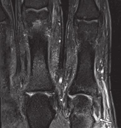 interphalangeal joint. Fig. 9 ollateral ligaments.
