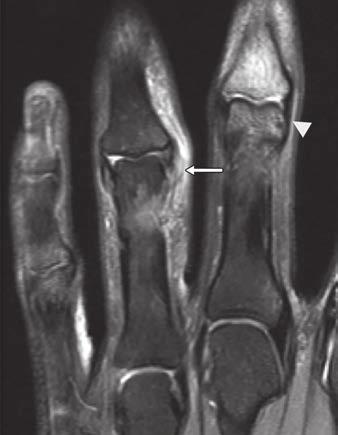 oronal proton density weighted fatsuppressed image shows tear of radial collateral ligament at attachment to metacarpal head (arrow).