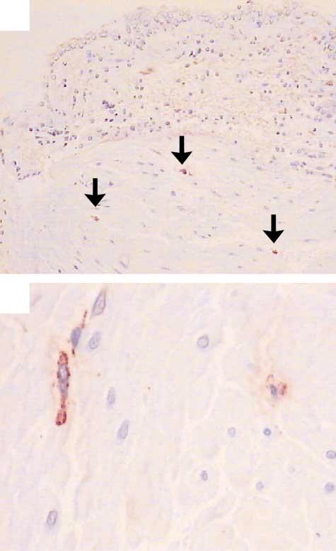 A B Figure 2. Bronchial-Biopsy Specimens from. Panel A shows epithelium, submucosa, and smooth muscle with mast cells (arrows) infiltrating the airway smooth muscle ( 100).