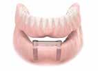 Implant Related Options Dental implants can be used for many different types of treatments.