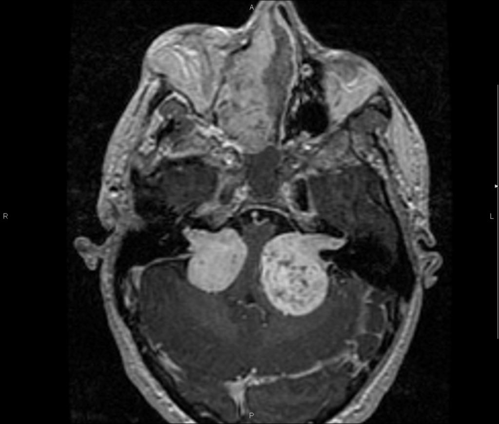 Fig. 4: Axial contrast-enhanced T1WI.