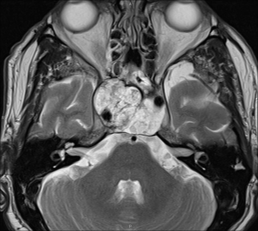 Fig. 9: Coronal, contrast-enhanced, T1WI with fat suppression.