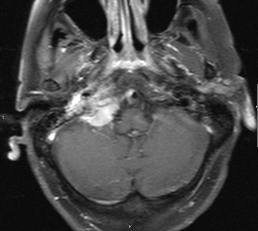 Fig. 16: Axial contrast-enhanced T1WI.