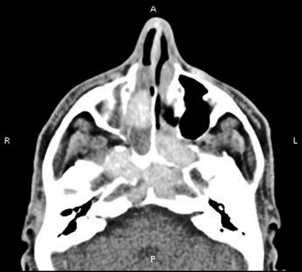 Fig. 17: Axial CT.