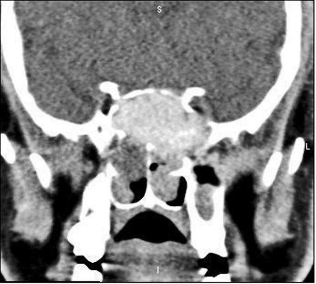 Fig. 18: Axial CT.