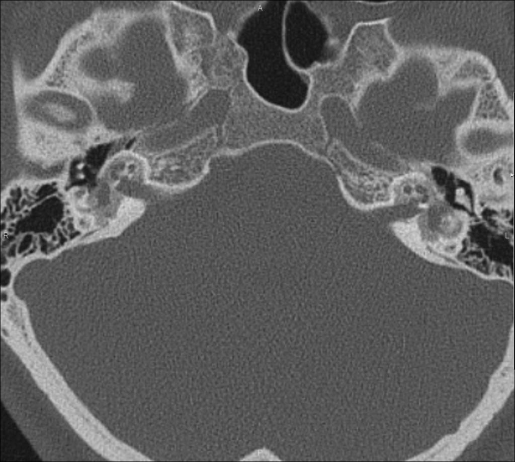 Fig. 19: Coronal CT.