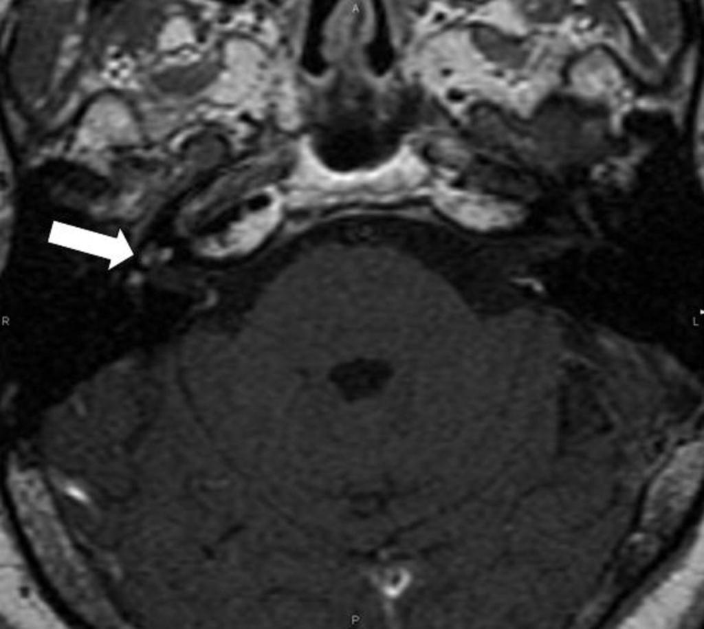 Fig. 20: Axial contrast-enhanced T1WI.