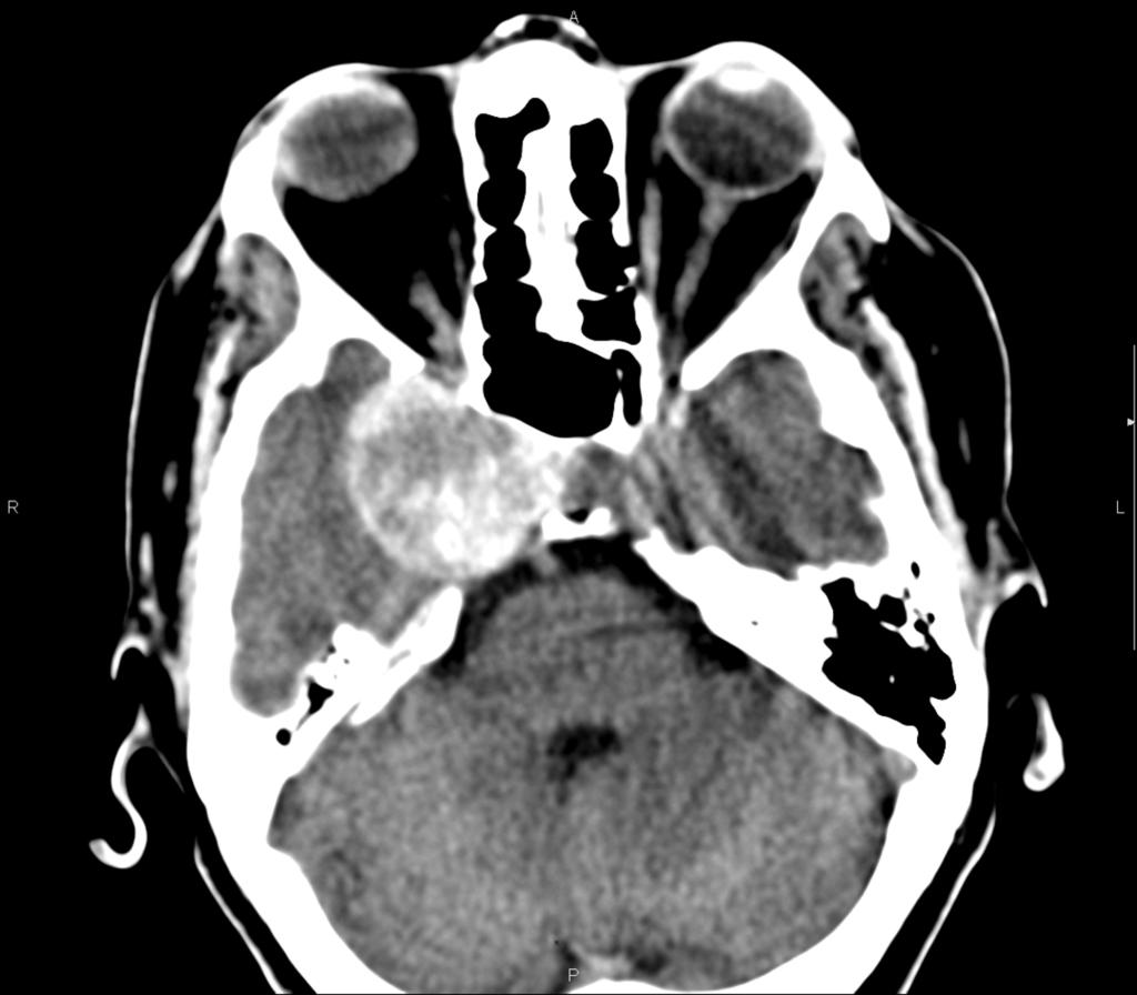 Fig. 21: Axial CT.