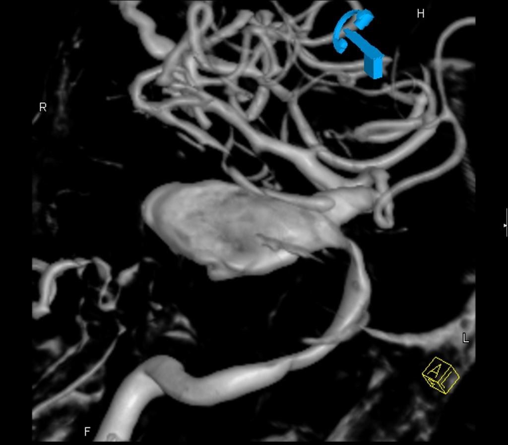 Fig. 24: 3-D angiographic