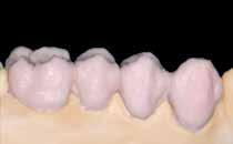 1 st Dentin and Incisal firing Isolate the model before layering the Dentin and Incisal materials. In this way, the ceramic material is prevented from drying out or sticking to the model respectively.