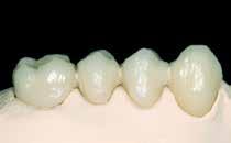 Make sure that the restoration is slightly overcontoured so that the actual tooth shape is achieved after firing.