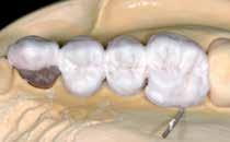 Thoroughly dry the restoration and complete the missing areas. Pay special attention to interdental spaces as well as contact points.