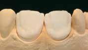 Important: Correct processing and properly degassed dies are an important prerequisite for accurately fitting veneers.