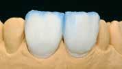 Incisal firing IPS InLine Veneers Subsequently, build up the outer enamel layer and fire.