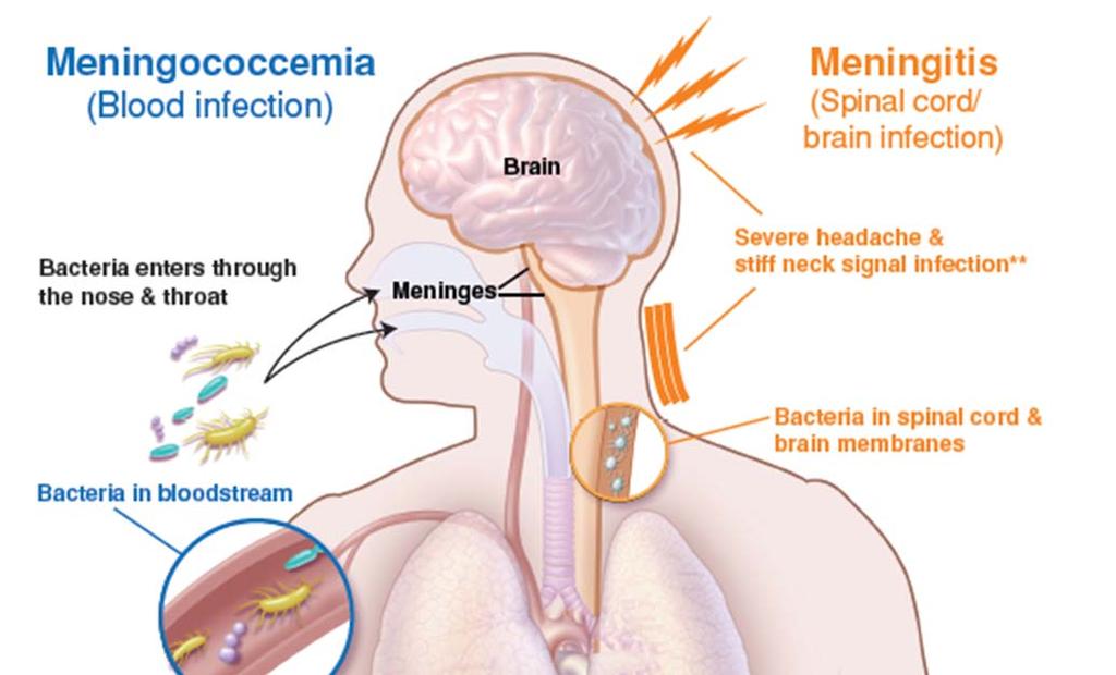 Meningococcal Disease: The Basics Rare, potentially deadly infection Sometimes called bacterial meningitis or meningitis Two common forms of infection