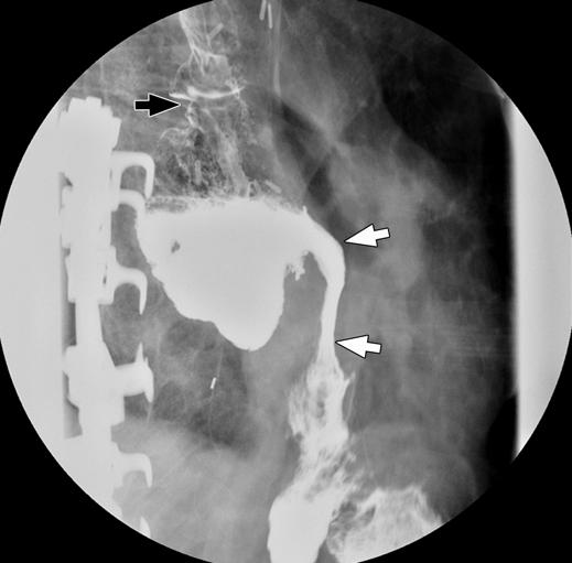 Note smooth contour and tapered margins (black arrows) of stricture.