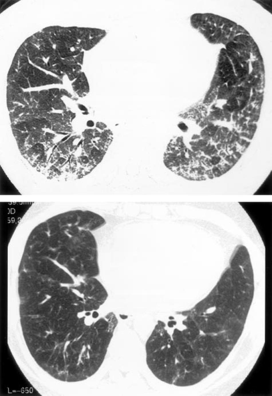 tion) in each zone of each lung and calculated the CT scan score in the same way. CT scan scores were compared between before and after treatments.