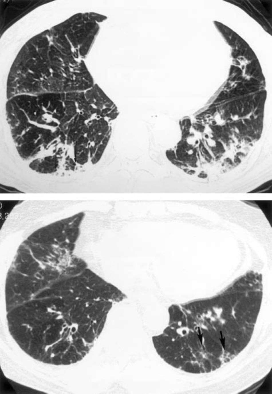 Figure 3. A 63-year-old woman with NSIP and DM in group II. Top: high-resolution CT scan of the lung bases showing a thickening of the septal lines and peripheral consolidation.