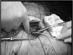 Procedure: Right or left femoral approach is used both groins will be accessed (1 side will be the cut down, the other will be a percutaneous access for other catheters, such as pacing