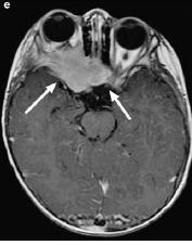 PET-CT 18-month-old