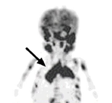 PET-CT 7-month-old