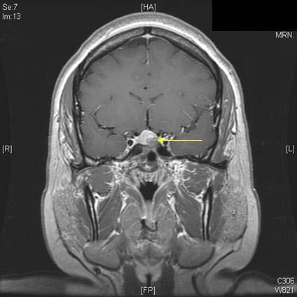 Companion Pt #1: Pituitary Microadenoma on MRI Note the round 9 mm by 9 mm pituitary microadenoma in the left side of the pituitary Distinguishing features of pituitary
