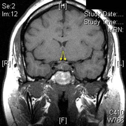 Companion Pt #1: Pituitary Microadenoma on MRI Notice the beautiful nearby anatomy that is