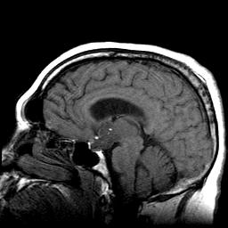 Companion Pt #2: Craniopharyngioma on MRI Note the large supersellar mass compressing the hypothalamus above and the