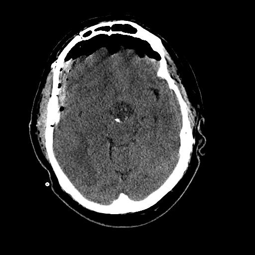 Companion Pt #2: Craniopharyngioma on CT Note the large supersellar mass compressing the hypothalamus above and the pituitary below