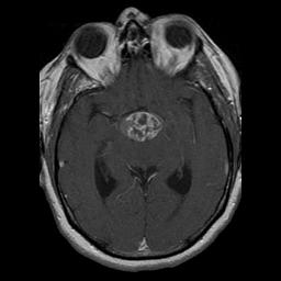 Companion Pt #2: Craniopharyngioma on MRI Note the large supersellar mass compressing the hypothalamus above and the pituitary below Distinguishing features of