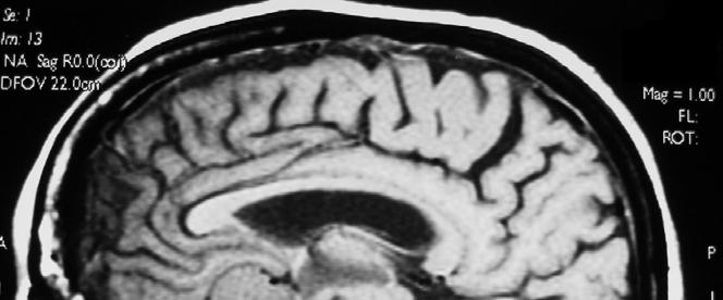 Companion Pt #3: Meningioma on MRI Note the large