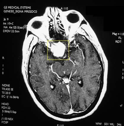 Companion Pt #3: Meningioma on MRI Note the large suprasellar mass Distinguishing features of meningiomas include: Typically suprasellar Rim of
