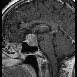 Note the sellar mass with the following distinguishing features: Our Patient: Sellar Mass on MRI Sellar