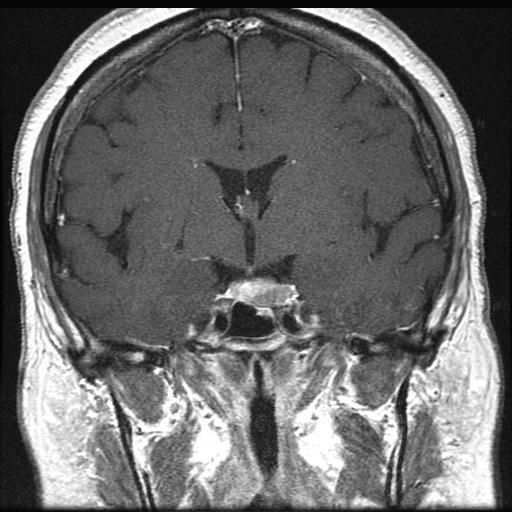 Note the following findings: Our Patient: Post-Surgery MRI Hypointense mass in the left pituitary Decompression of the