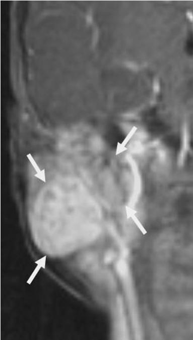 Parenchymal in- C D E F Fig. 16. rhabdomyosarcoma in a 4-year-old boy.
