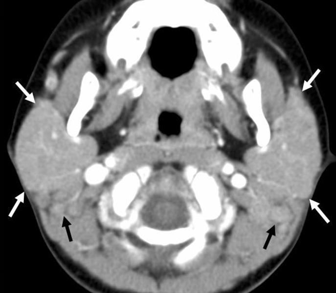 volvement shows diffuse infiltration with an ill-defined margin. n enlarged gland with increased vascularity within the lesion is seen with a lymphoma (11).
