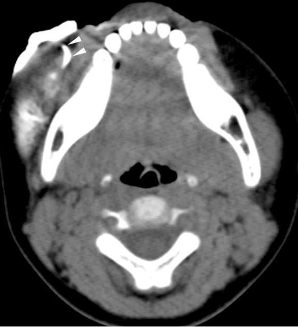 Developmental Disorders Congenital genesis of the Parotid Gland genesis of the parotid gland is a rare entity. It usually Fig. 19. parotid lymphatic malformation in a 6-year-old girl.