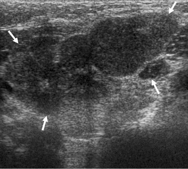Fig. 24. Langerhans cell histiocytosis in a 7-month-old girl.. US image of the parotid gland shows multiple aggravated low echoic nodules within the enlarged gland. (arrows).