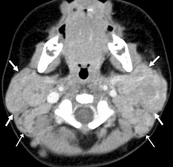 Multiple enlarged lymph nodes are also seen in both necks (thin arrows). on radiological findings. Thus, a biopsy and consideration of its unique clinical features are necessary.