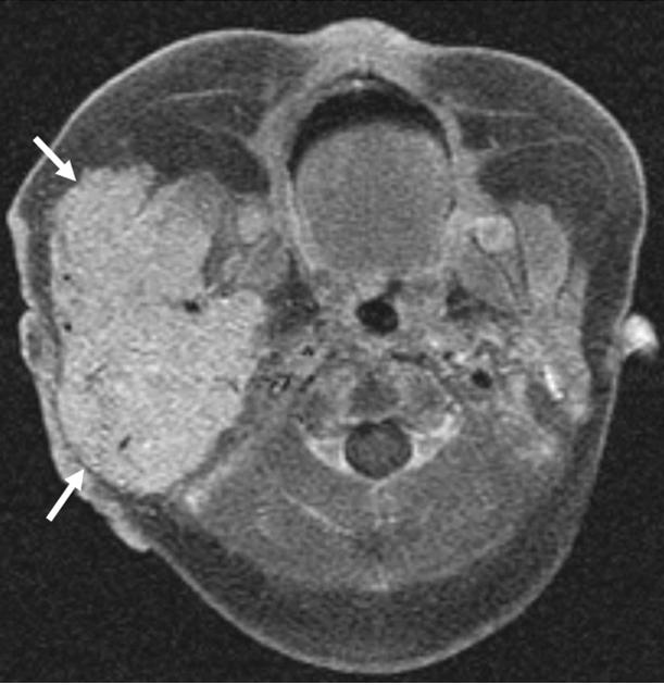 With the use of contrast-enhanced CT, hemangiomas are visualized as well-demarcated masses with intense homogenous enhancement.