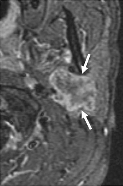 cell carcinoma. Technetium 99m scintigraphy can help to diagnose Warthin s tumor, as the tumor shows higher uptake of the radioisotope than the normal gland parenchyma (11).