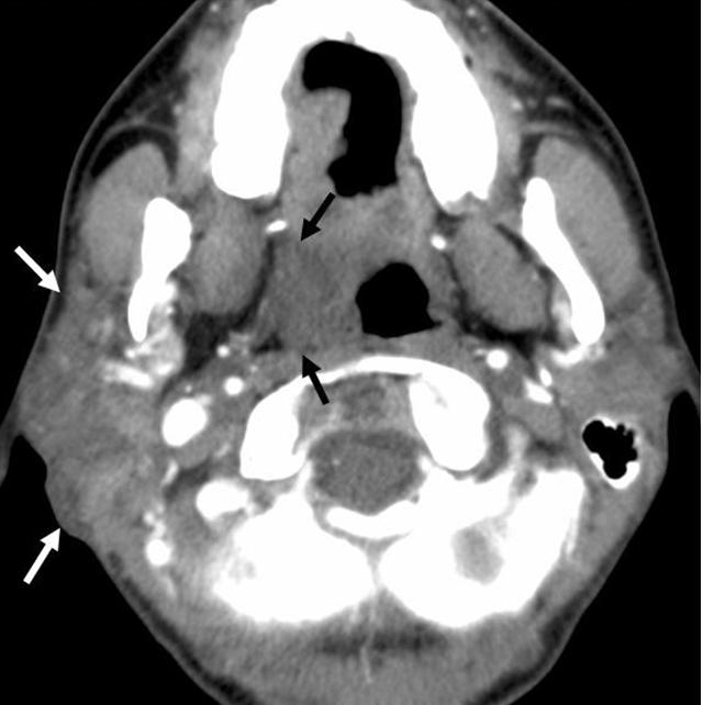 On an axial contrast-enhanced CT scan, a diffuse ill-defined low attenuated lesion replaces the entire right parotid gland (white arrows).