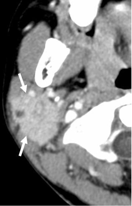 ported to be the second most common parotid malignancy after an MEC in the pediatric population (5, 9). Imaging findings of CCs are nonspecific (Fig.