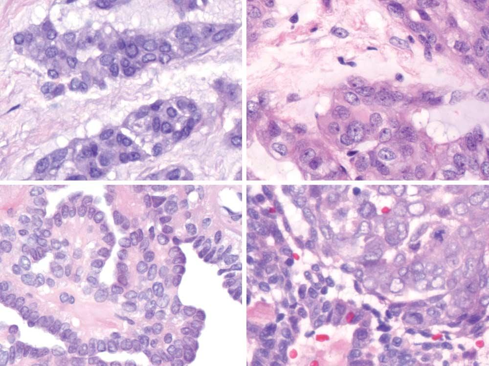A B C D Figure 4. Two paired cancers with histologic progression (hematoxylin-eosin staining used in all parts of Figure).